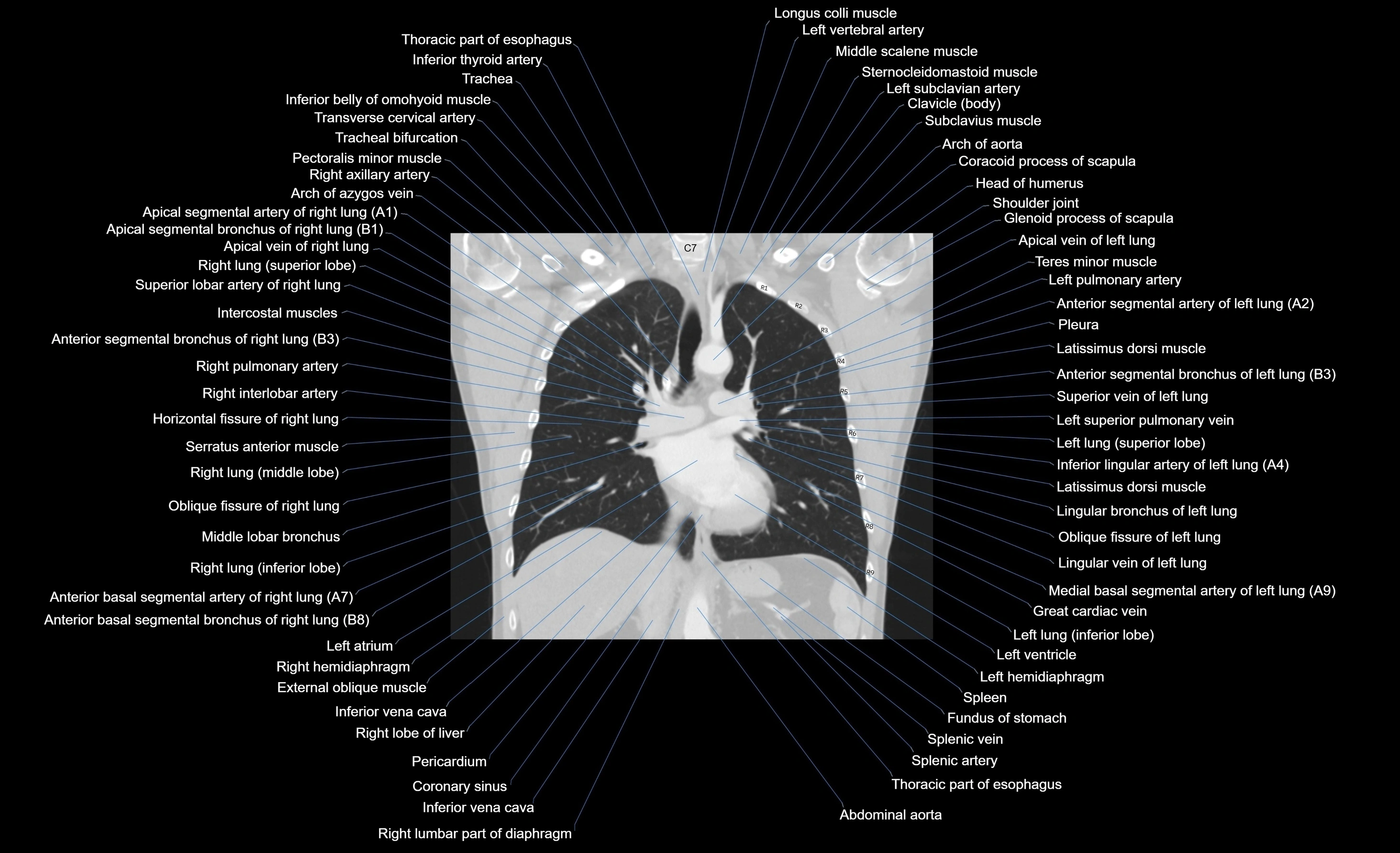 CT chest (thorax) labelled coronal cross sectional anatomy radiology image-00060.webp